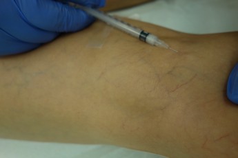Žilky na nohách - sklerotizace