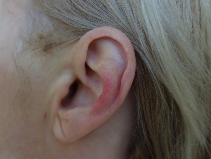 Hematom na ušním boltci z nepadnoucí ohlávky, byl bolestivější než celý zákrok dohromady.