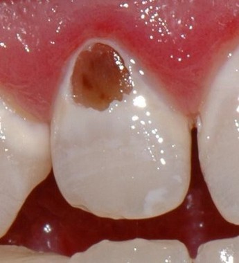 Dentální hygiena - zubní kaz