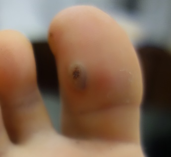 Odstranění bradavic tekutým dusíkem