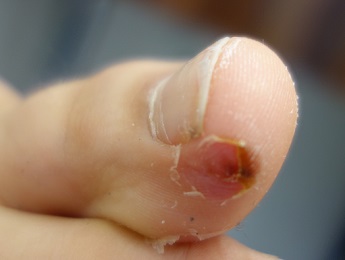 Odstranění bradavic tekutým dusíkem