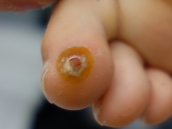 Odstranění bradavic tekutým dusíkem