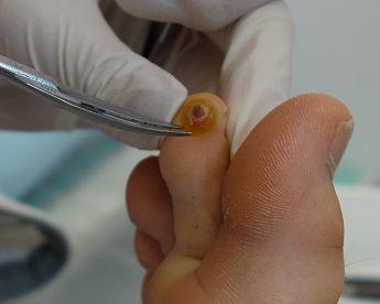 Odstranění bradavic tekutým dusíkem