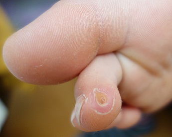 Odstranění bradavic tekutým dusíkem