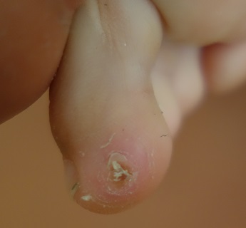 Kůže po odstranění bradavic po 3-4 kúrách aplikace tekutého dusíku a následném zhojení.