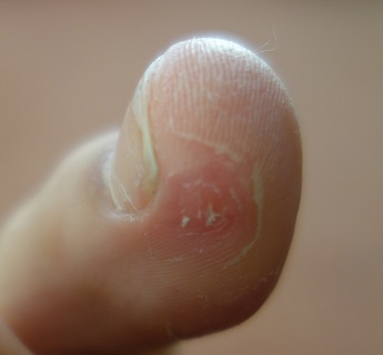 Stav po zmražení tekutým dusíkem