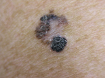 Nodulární melanom
