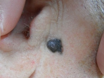 Nodulární melanom