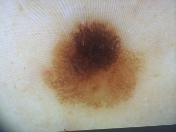Melanoma in situ vzniklý na podkladě stávajícího znaménka