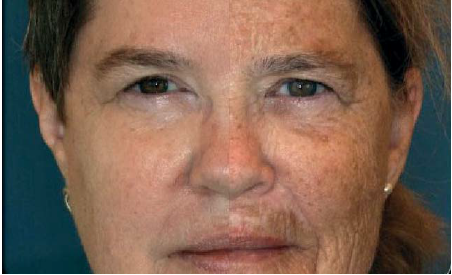 Rozdílnost stárnutí kůže obličeje u jednovaječných dvojčat