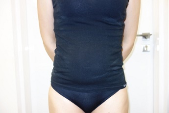 Stav před laserovou liposukcí břicha