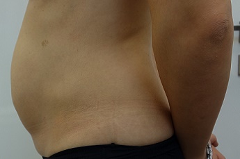 Stav před laserovou liposukcí břicha
