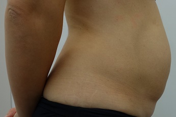 Stav před laserovou liposukcí břicha