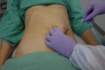 Aplikace tumescentní anestezie, rozvolnění tuku.