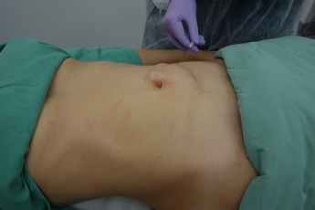 Aplikace tumescentní anestezie, rozvolnění tuku.