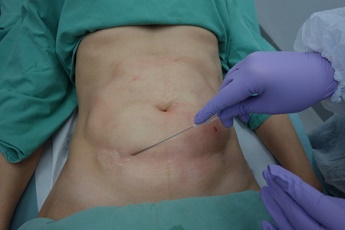 Rozpuštění tuku laserem a odsátí roztátého tuku.