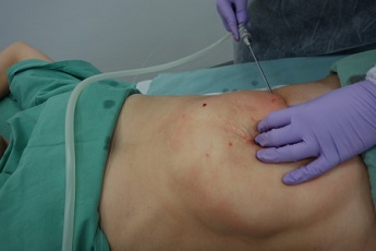 Rozpuštění tuku laserem a odsátí roztátého tuku.