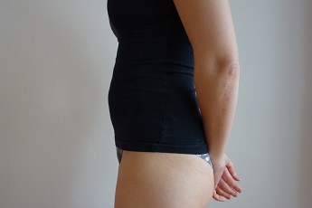 Stav po laserové liposukci břicha