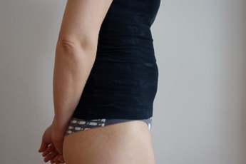 Stav po laserové liposukci břicha