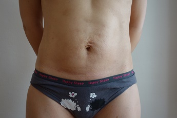 Stav po laserové liposukci břicha