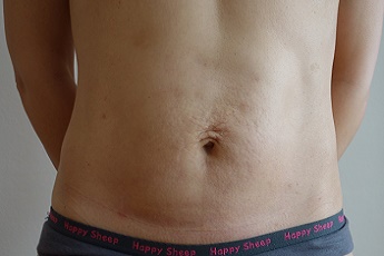Stav po laserové liposukci břicha