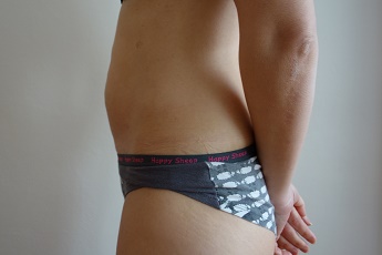 Stav po laserové liposukci břicha