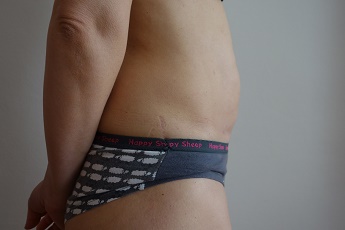 Stav po laserové liposukci břicha