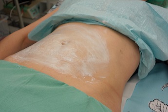 Aplikace znecitlivujícího krému.