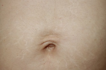 Pokožka břicha po zákroku