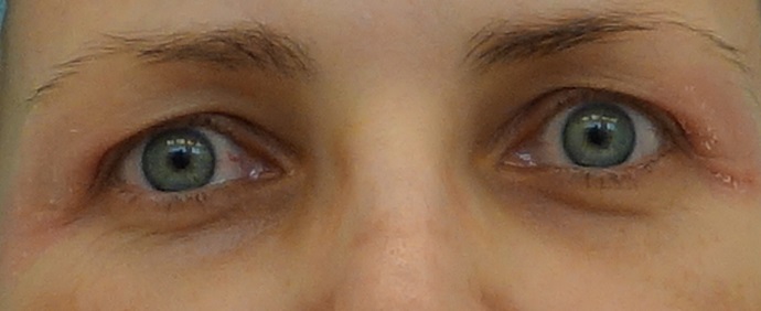 Oči 14 dní po zákroku
