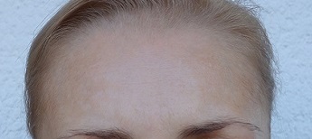 Snížení pigmentace v oblasti čela.