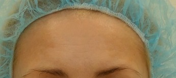 Snížení pigmentace v oblasti čela.