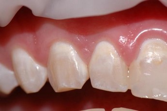 Dentální hygiena - demineralizace skloviny