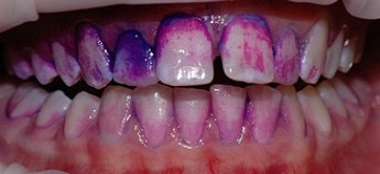 Dentální hygiena - zubní povlak