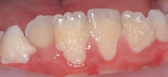 Dentální hygiena - zubní povlak