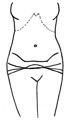 Abdominoplastika