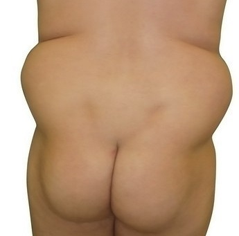 Liposukce břicha - před zákrokem