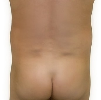 Liposukce břicha - po zákroku