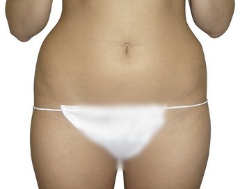 Liposukce břicha - před zákrokem