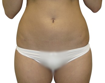 Liposukce břicha - po zákroku