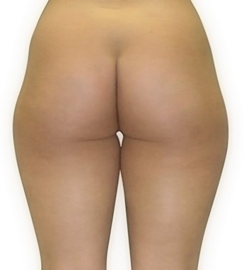 Liposukce stehen - po zákroku