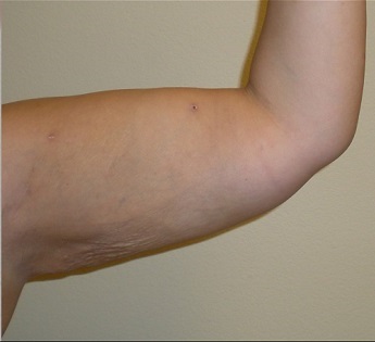 Liposukce paží - po zákroku
