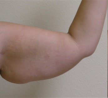 Liposukce paží - před zákrokem