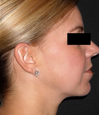 Liposukce podbradku - po zákroku