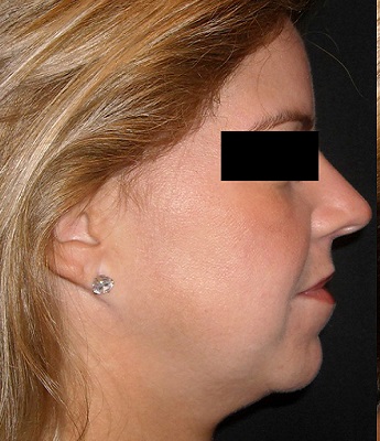 Liposukce podbradku - před zákrokem