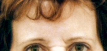 Před operací čela