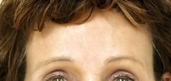 Srovnání po operaci čela